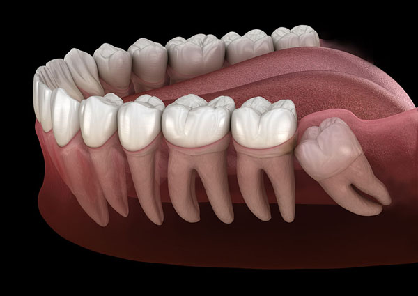 wisdom teeth