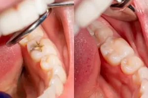 before and after dental bonding treatment