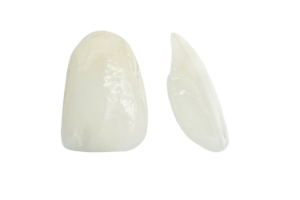 dental veneers