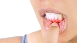 inflammation of the gums