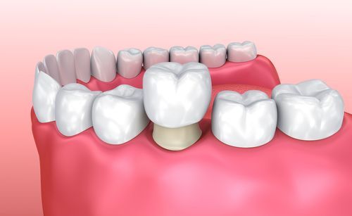 dental crown