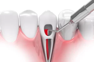 root canal therapy illustration
