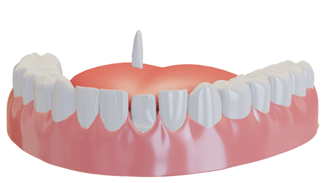 dental veneers