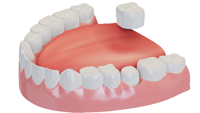 dental crowns