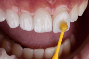 veneers being placed